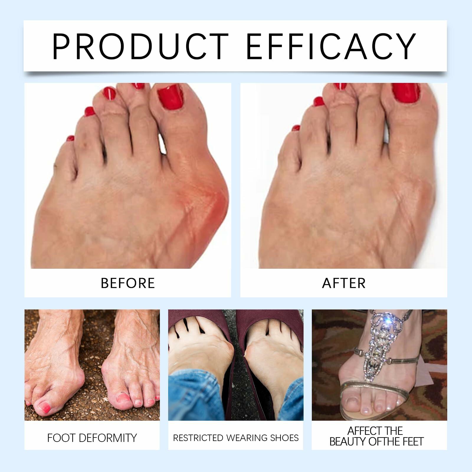 Befada Bunion Cushions Patch Waterproof Adhesive Pads for Men & Women 10 Tablets